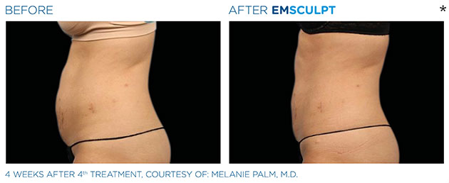 Before and After Photo of abdomen scultping Treatment in San Francisco